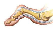 podologie - aandoening van de tenen, hamertenen