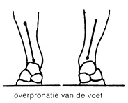podologie, aandoening gangpatroon, overpronatie van de voet